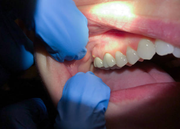 Best Emergency Root Canal Treatment in Central High, OK